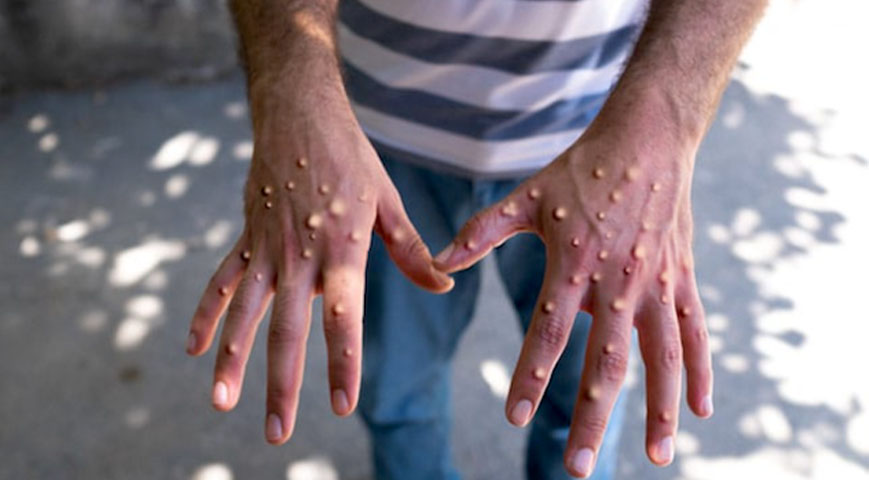 Ministry Of Heath Confirms Third Mpox Case In Nairobi